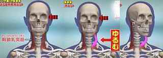 brain_malfunction_stiff_shoulders_hanger_reflex_4.jpg