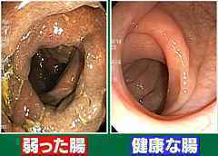 healthy_colon_weakend_colon.jpg