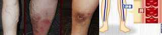 varicose_vein_ippuku_1.jpg